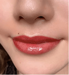 dazzy lipの症例写真