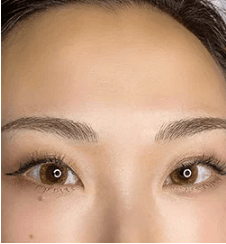natural browの症例写真