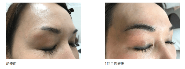 3Dアートメイクの症例写真