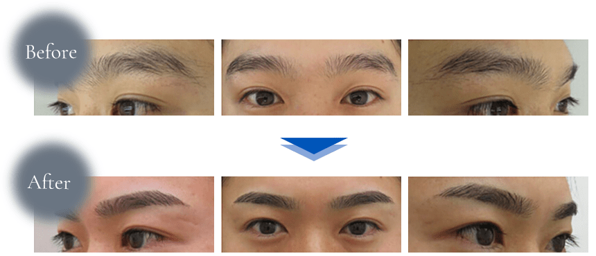 Dクリニック東京（D-BROW）、メンズアートメイクの症例写真